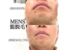 ヒパヒパ(Hipahipa!)の雰囲気（ヒゲ脱毛始めました♪最新のLED脱毛は痛みが少なく完了が早い☆）