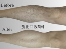 脚のビフォーアフター、施術5回でかなり生えにくく◎