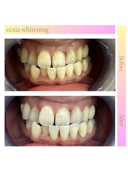 エクシアホワイト 倉吉店(ecxia white)/ビフォーアフター