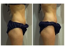 ラヴィエール(Laviere)/【レディース痩身120分】