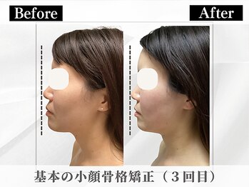 ポーベルポー(Peau Belle poe)/基本の小顔骨格矯正|3回目