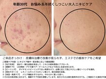 パルテール/ニキビ改善プロジェクト