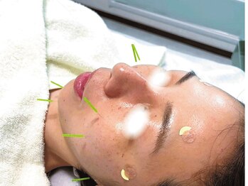 ハリドット 天王寺院(HARI.)/置鍼時間