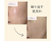 エキュロ 敦賀店(equro)の雰囲気(繰り返す肌荒れも肌環境を整え、根本改善へと導きます◎)