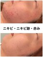 ビオプラス(BioPlus+)&nbsp;ニキビケア 専門サロン