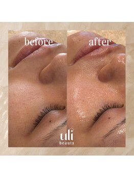 ウリ(uli beauty)/比較写真