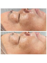 ヴィアス(VIAS)/プラズマフェイシャル　3回目