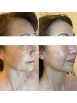 ルミライ(Lumirai)/ 小顔だけじゃない美肌も一緒に