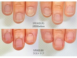 短い爪の悩みを卒業