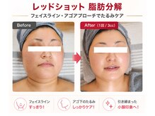 セレブリティ(Celebrity)の雰囲気(脂肪分解REDショットで小顔たるみケア#リフトアップ)