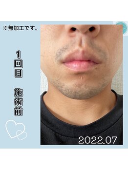 エンドモウ(END MOU)/ひげ脱毛の方も◎