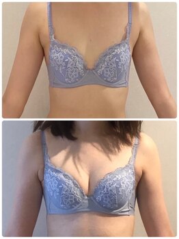 リール 恵比寿店(RIRE)/バストアップ症例【広尾恵比寿】