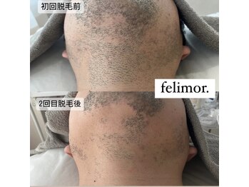 フェリモール(Felimor.)/メンズ光脱毛