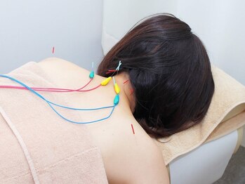 ピアーズ鍼灸整骨院の写真/【首肩改善60分¥6,600】辛いコリには鍼灸でアプローチ!原因を的確に把握し固まった筋肉をほぐし徹底改善◎