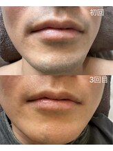 プライベートサロン アール(R)/部分脱毛(鼻下口周り・あご)