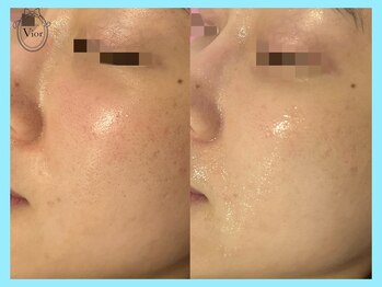 ハーブピーリング 名古屋/TETEピール　赤み解消