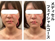 プラマイル(Pramile)/メディセルフェイシャルコース