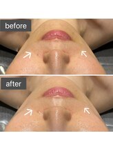 ロッタ エクリュ(Lotta ecru+)/REVI剥けないハーブピーリング