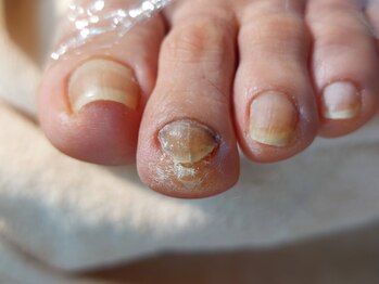 爪切り屋 足楽/爪肥厚と胼胝◆第2趾