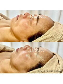 サロン ド ブラン アオヤマ(Salon de BLANC AOYAMA)/BLANC式小顔/水艶肌ソノケア