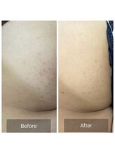 アーユルヴェーダアンドアロマエステ アユス(AYUS)/ハーブピーリング　ヒップ