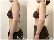 リリィブラン(Lily branc)/ブライダル痩身/背中&二の腕