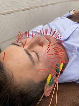 長寿鍼灸院 長寿整骨院/美容鍼100本の効果★小顔効果