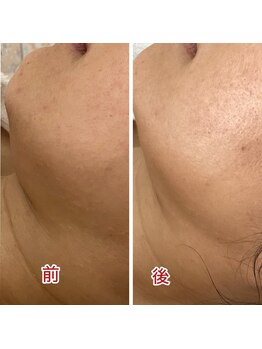 ハズキ(HAZUKI)/お肌上げたい/ほうれい線/引き上