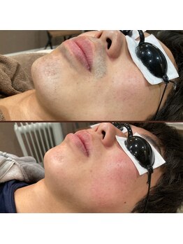 メンズキュー(Men's Cue)/脱毛4ヶ月