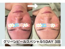 ルーチェ(LUCE)の雰囲気（最高級ハーブピーリング◎で赤みトラブルもお任せ下さい！！）