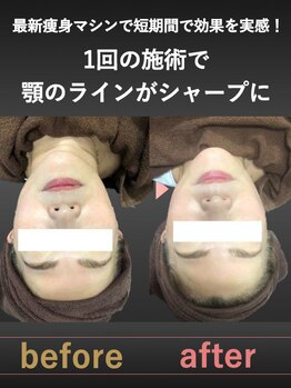 蓮子の夢/フェイスラインもすっきり！