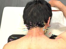 とだ鍼灸院/《鍼灸施術》寝違えも対応◎