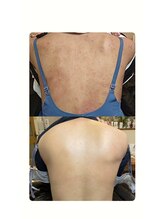 ソリッジ肌管理室/背中のケア