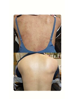 ソリッジ肌管理室/背中のケア