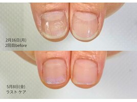 短い爪の悩みを卒業