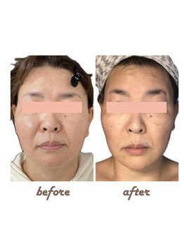 サンボーテ(Sanbeaute)/小顔ホットフェイシャル