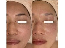 シェリール(Cherir)/ACトリートメント