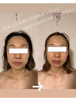 エクレクティック(ECLECTIC)/テラボーラー/宇都宮小顔エステ