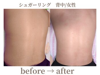 サロンラペーシュ(Lapeche)/シュガーリング befor→after