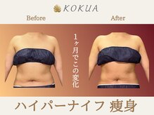 痩身専門店エステティックサロン コクア(KOKUA)の雰囲気（【ハイパーナイフ】脂肪を徹底分解！）
