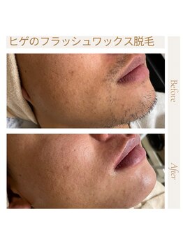 オフオルファヴォリ(OF Olu:Favori)/【フラッシュワックス脱毛】