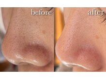 ルアナ(Luana)の雰囲気(ハイドラフェイシャルで脱いちご鼻!!毛穴洗浄で潤い美肌に!)