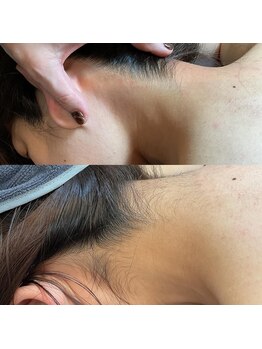 ミセルラボラゾ 久留米店(Misel Labo Lazo)/BeforeAfter