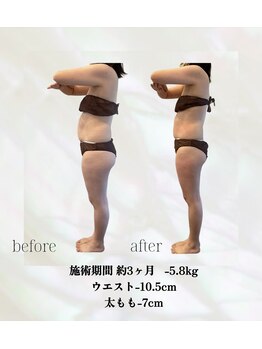 カリス(charis)/施術期間3ヶ月