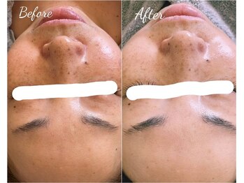 アンカシェット(en cachette)/ラミネーションピール