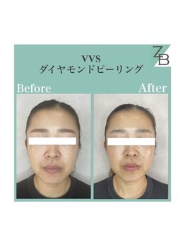 ザラハビューティー(ZARAHA Beauty)/VVSダイヤモンドピーリング