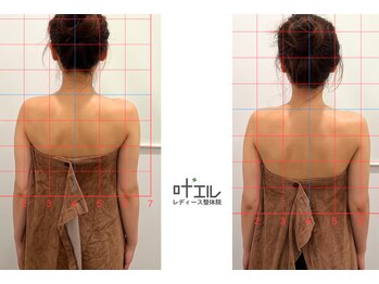 叶'エル 本町 心斎橋院/肩甲骨/肩甲骨はがし/天使の羽