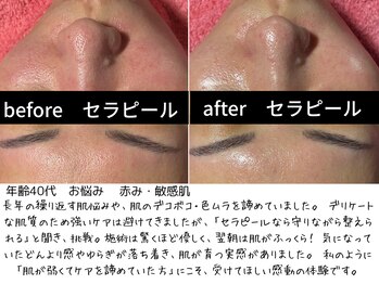 パルテール/赤み・敏感肌が悩み【口コミ】