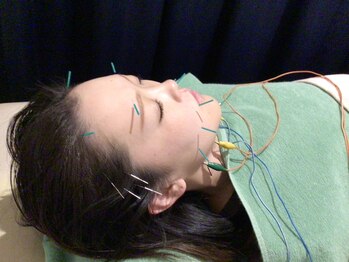 ごえん 四日市店の写真/【美容鍼で小顔効果!!】数少ない女性鍼灸師による施術でリラックスして受けられる♪男性も大歓迎です☆