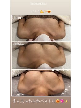 マイントゥー(mine too)/バストUP症例